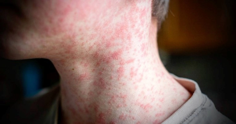 SZO i Unicef pozivaju na brzu reakciju u rješavanju problema epidemije ospica u BiH